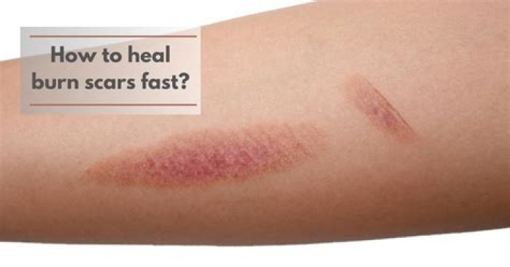 How do you get rid of brown burn marks