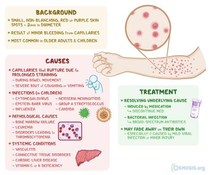 How do you get rid of coxsackievirus