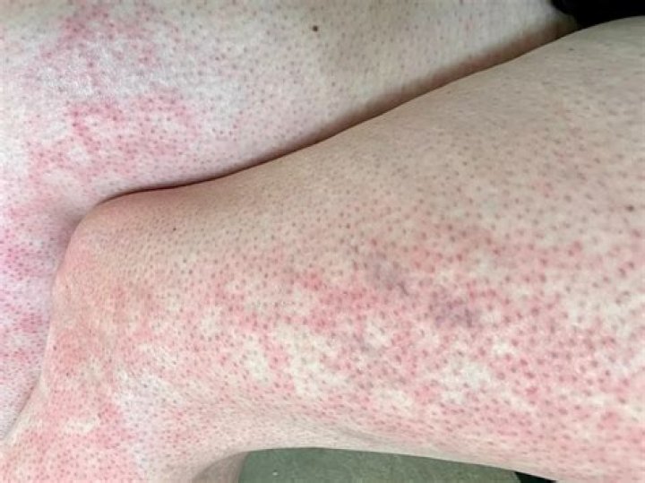 How do you get rid of erythema IGNE