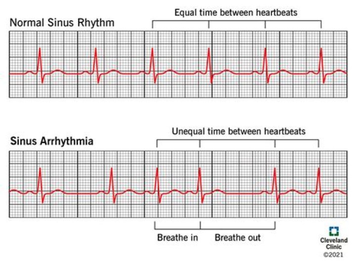 How do you interpret sinus rhythm