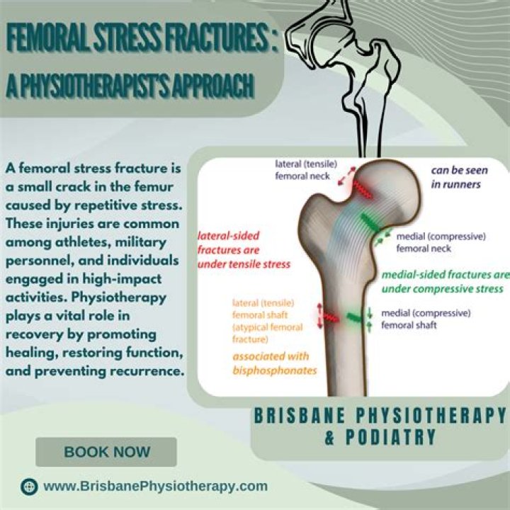 How do you know if you have a femoral stress fracture