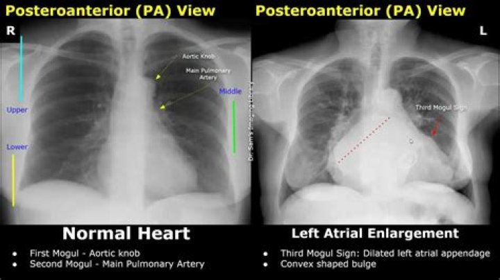 How do you know if you have right ventricle enlargement