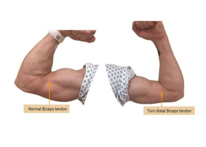 How do you know if you tore your bicep