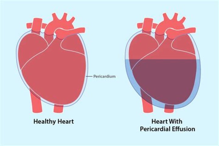 How do you stop pericardial fat