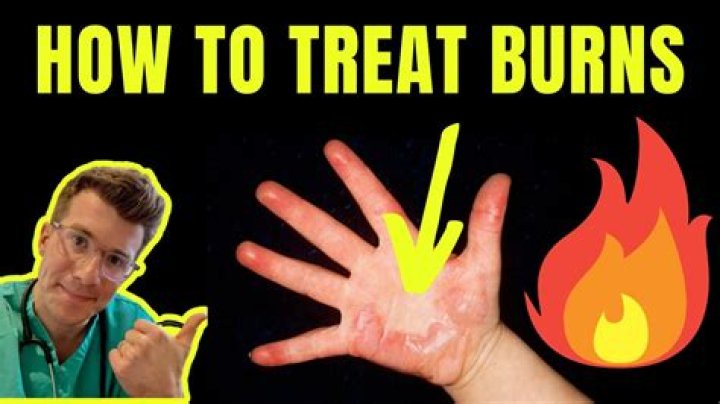 How do you treat a bad grass burn