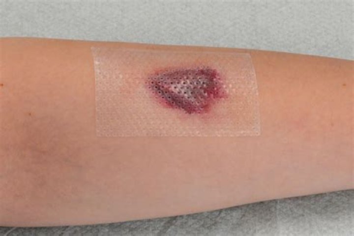 How do you treat a skin tear