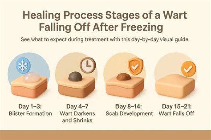 How do you use one step wart in the freezer