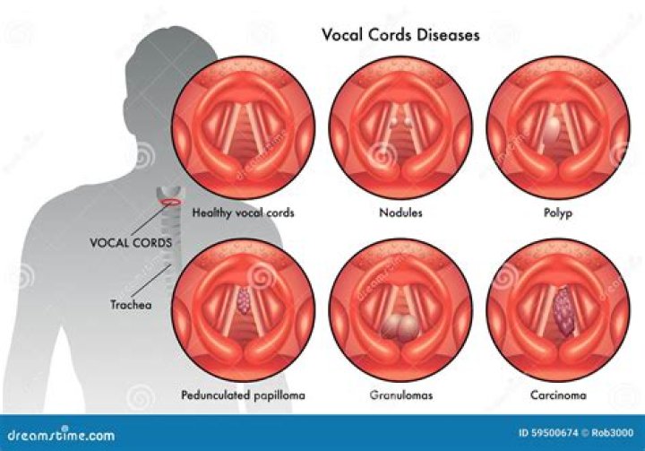 How does Parkinsons affect the vocal cords