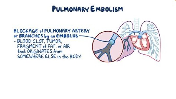 How does pulmonary embolism cause atelectasis