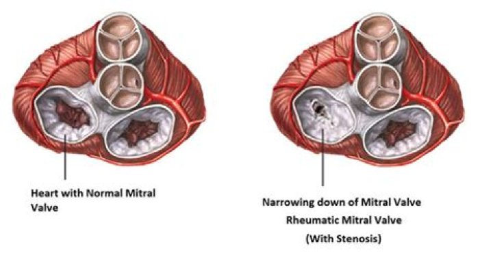 How does rheumatic fever affect heart valves