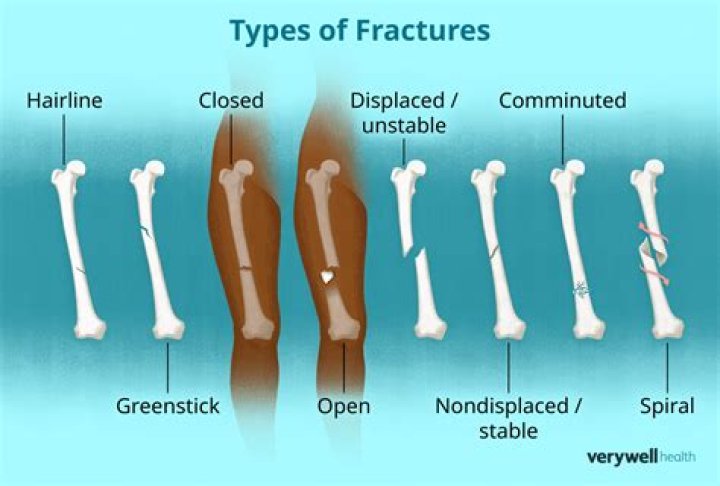 How is a buckle fracture treated