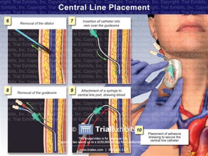 How is a central line inserted