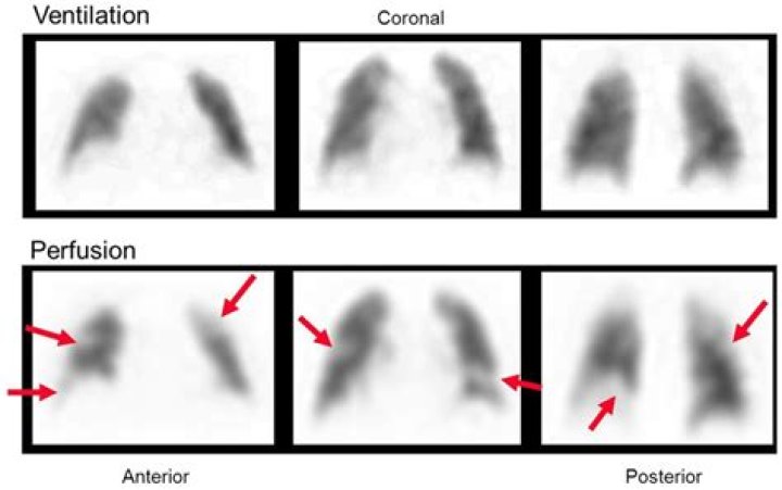 How is a VQ lung scan performed