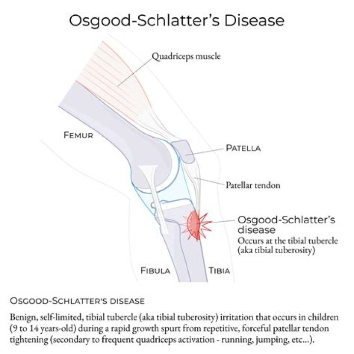 How is Osgood Schlatter diagnosis