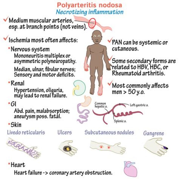 How is polyarteritis nodosa diagnosis