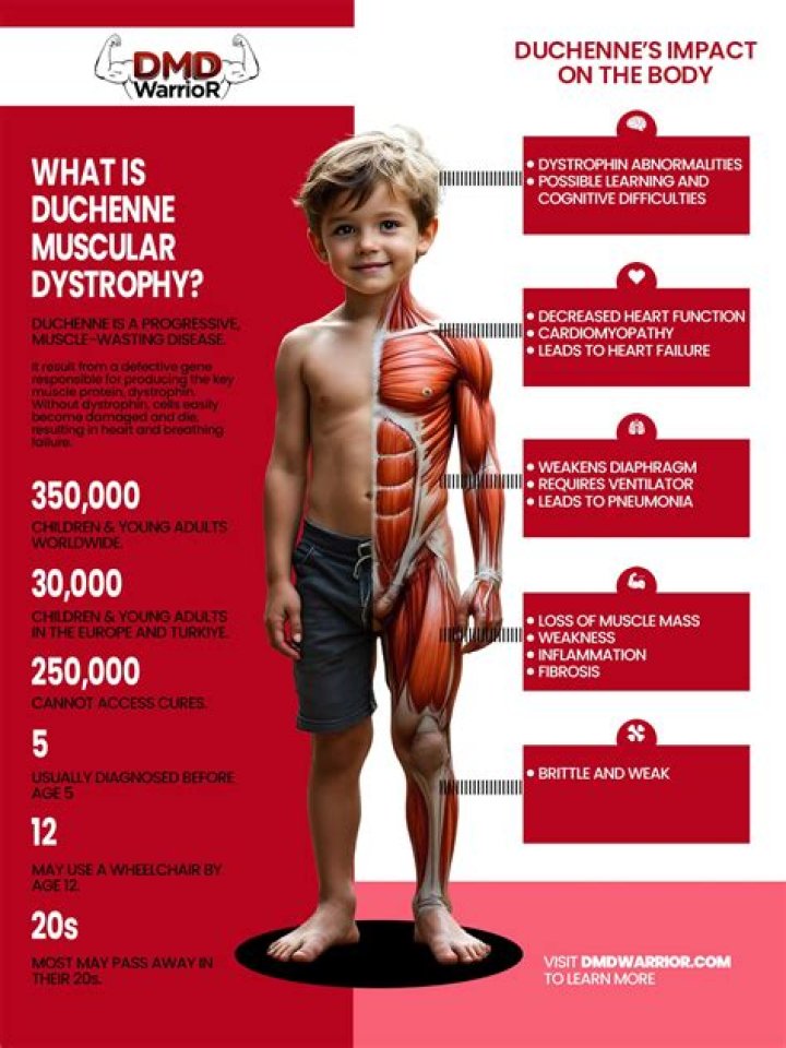 How long can you live with Duchenne muscular dystrophy