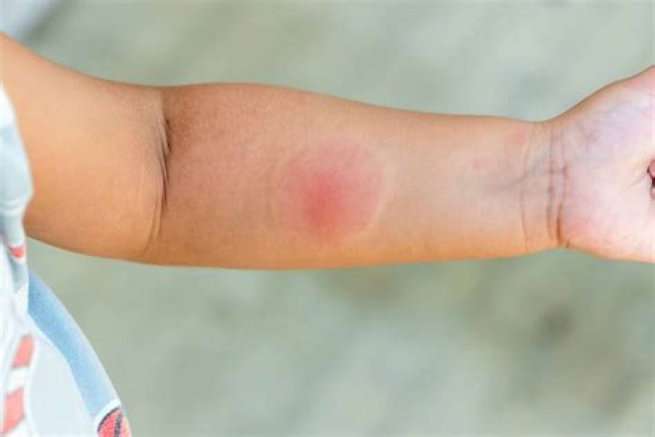 How long do leech bites last