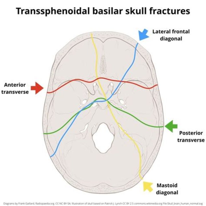 How long does a basilar skull fracture take to heal