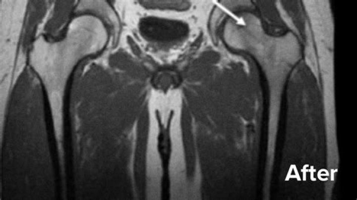 How long does a hip labral tear take to heal