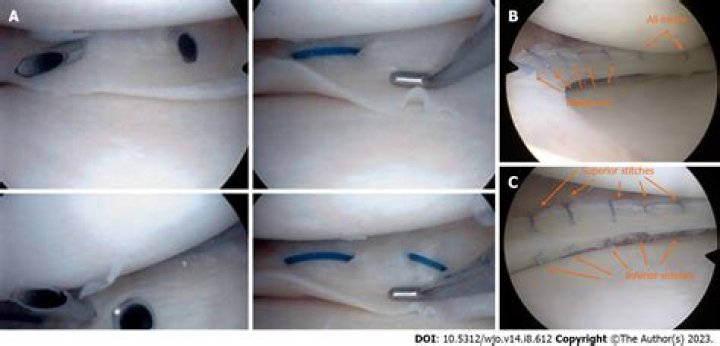 How long does it take to recover from a meniscectomy