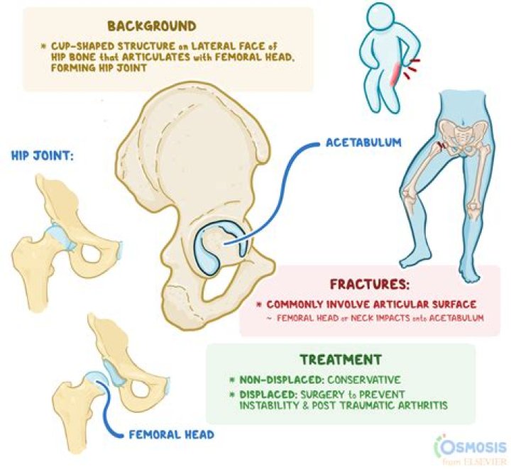 How long does it take to recover from an acetabulum fracture