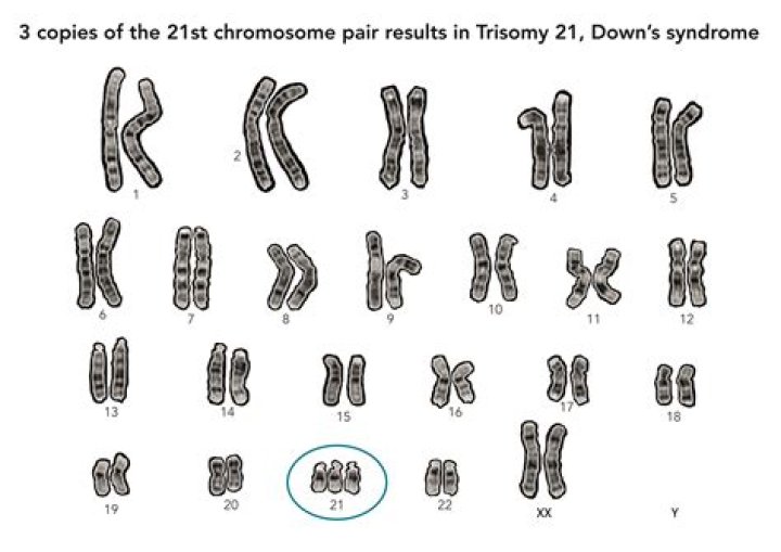How many chromosomes does someone with trisomy 21 have