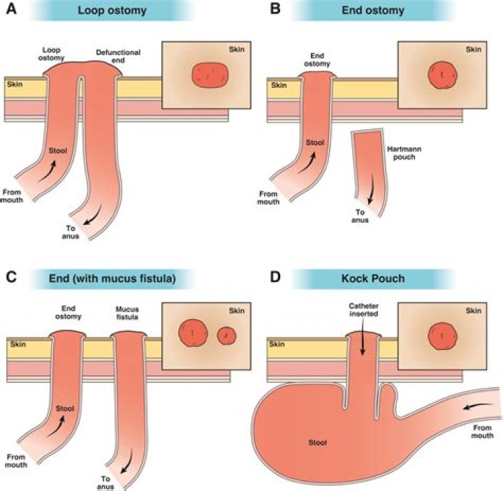 How many types of colostomy are there