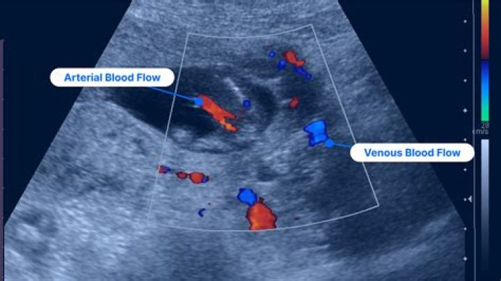 How much does a venous Doppler cost