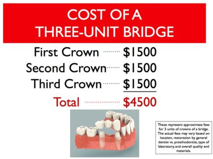How much does it cost for a bridge for teeth