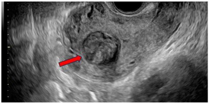 How rare is a STUMP tumor