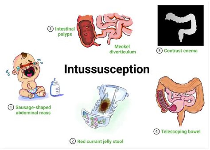 How serious is intussusception