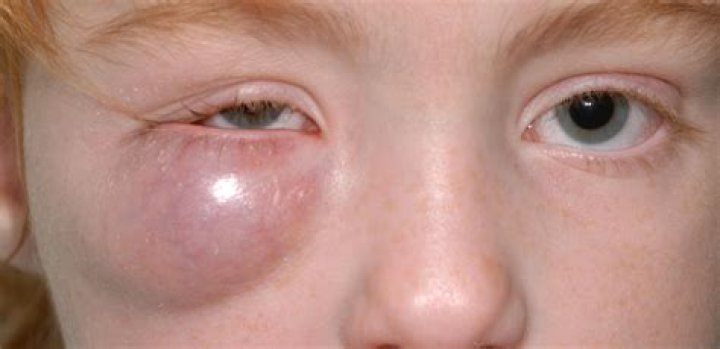 How serious is periorbital cellulitis