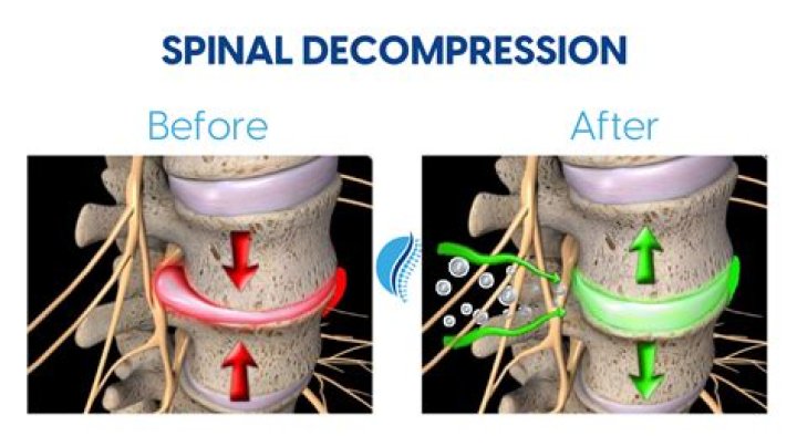 How successful is decompression surgery
