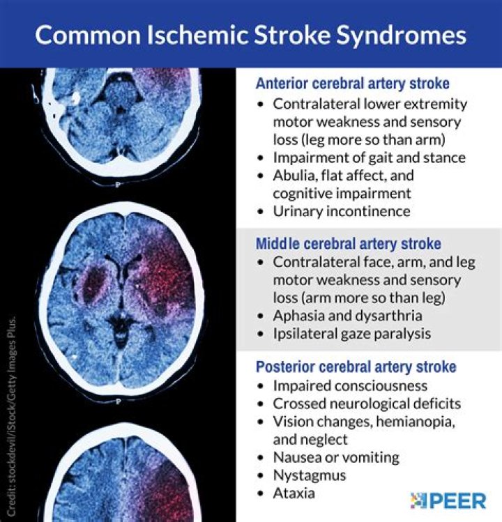 Is a cerebral artery occlusion a stroke