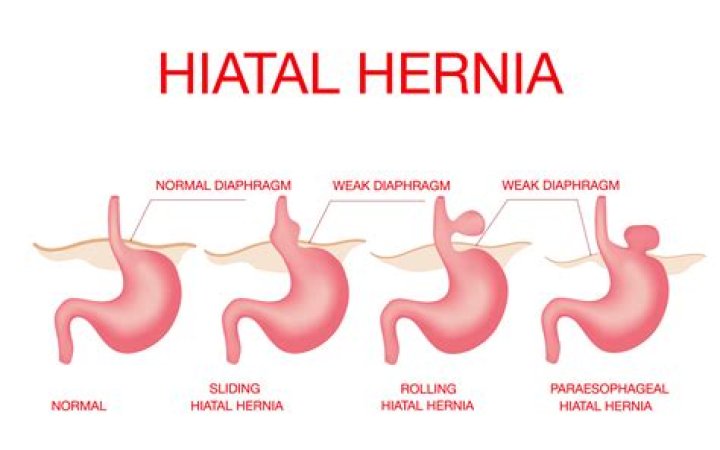 Is a hiatal hernia dangerous