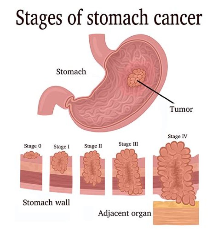 Is a stomach tumor always cancer