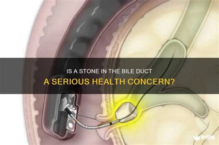 Is a stone in the bile duct serious
