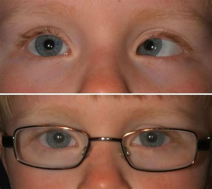 Is amblyopia a form of strabismus