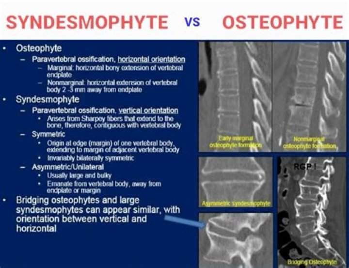 Is an Osteophyte the same as a bone spur