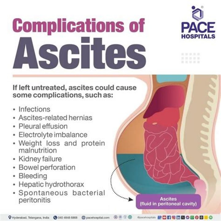 Is ascites a sign of advanced cancer