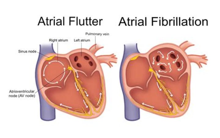Is atrial flutter an emergency