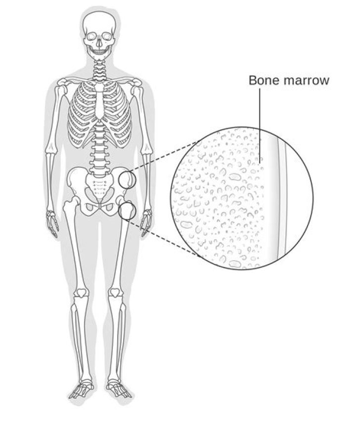 Is bone marrow cancer curable
