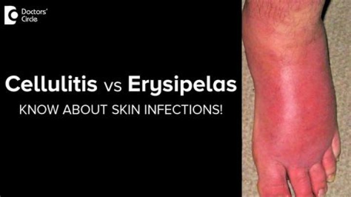 Is erysipelas contagious