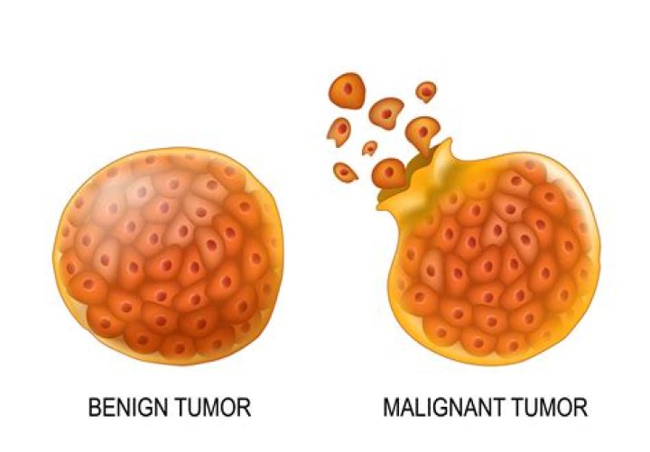 Is hepatoma benign or malignant