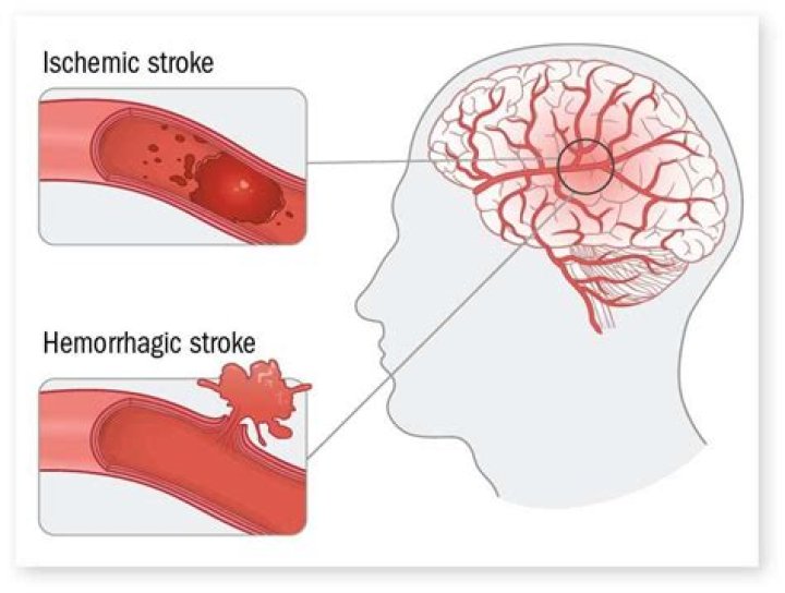Is ischemic or hemorrhagic stroke worse