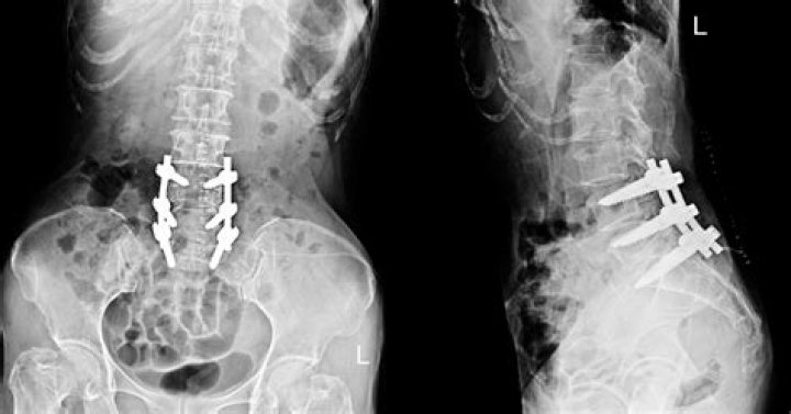 Is laminectomy a major surgery