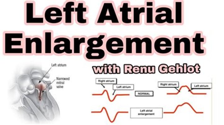 Is left atrial enlargement dangerous