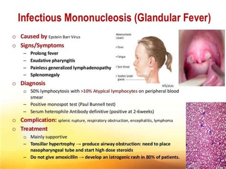 Is Mono the same as glandular fever
