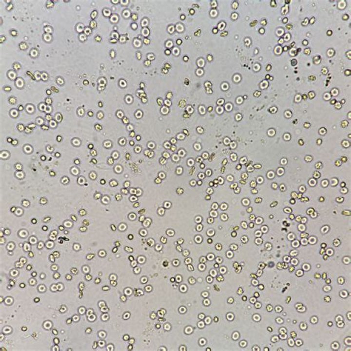 Is occasional RBC in urine normal