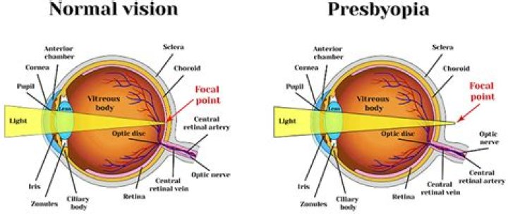 Is presbyopia a medical diagnosis